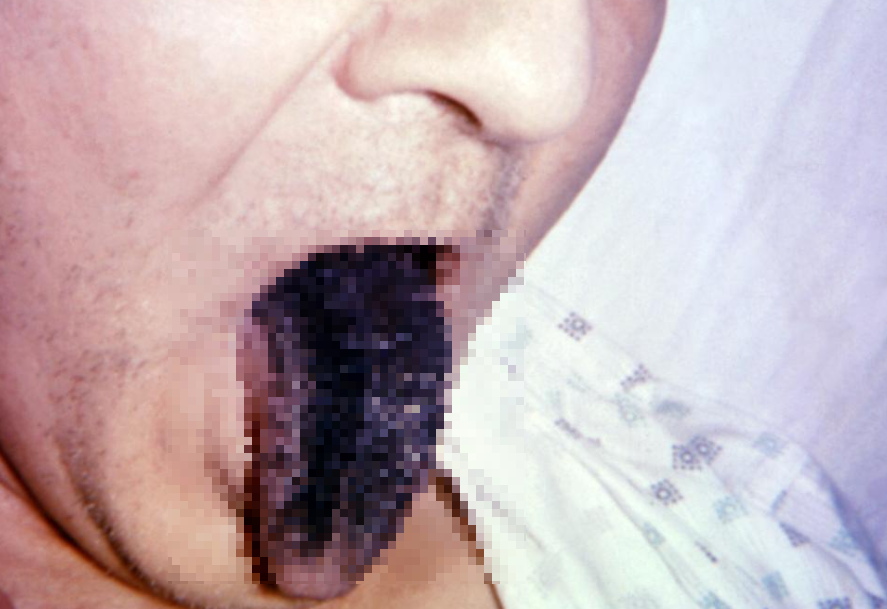 恐怖! 知名女作家染疫后去世 舌头上长黑毛! 罕见新冠症状太吓人: 500患者中就有1人得 新闻 第8张
